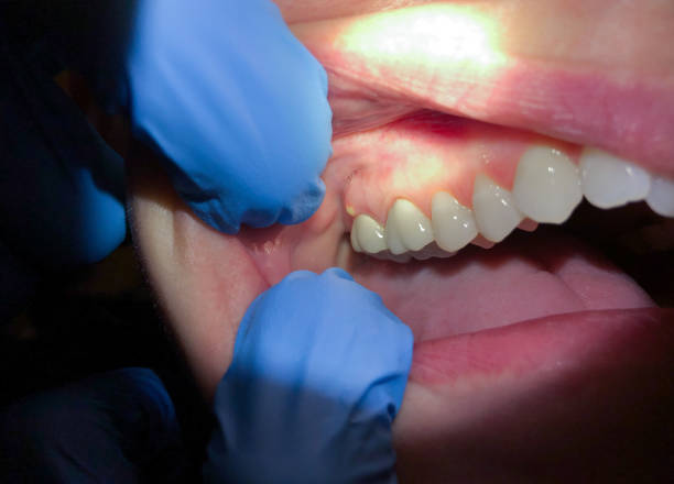 Best Emergency Gum Treatment in Miami Lakes, FL